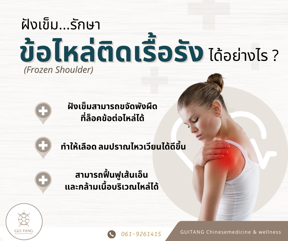 ฝังเข็มรักษาไหล่ติดเรื้อรัง (Frozen Shoulder)