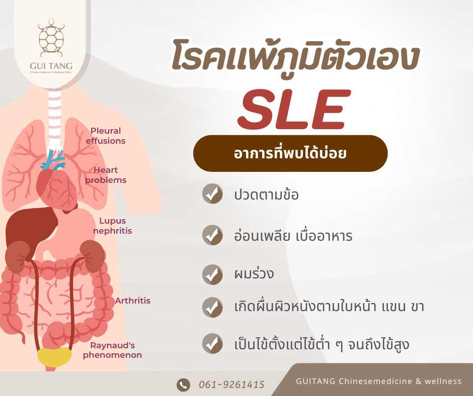 SLE รักษาด้วยแพทย์แผนจีน