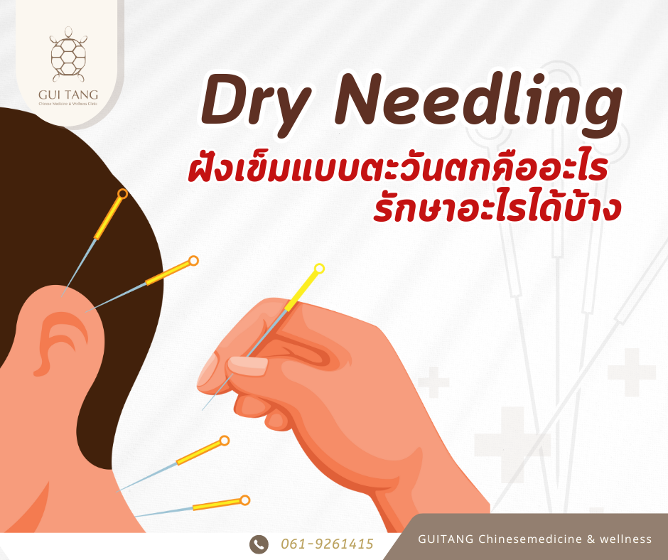 Dry needling บอกลาทุกอาการปวด